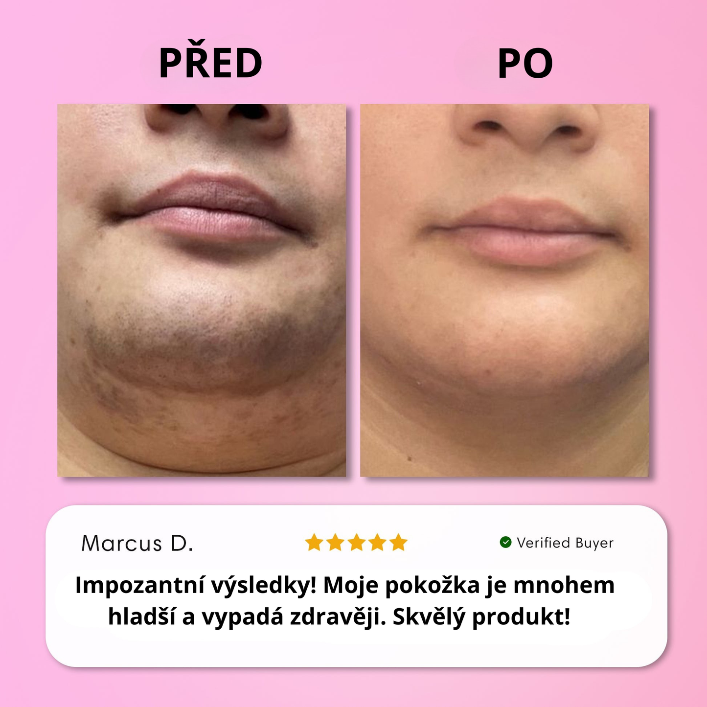 Sada na okamžité odstranění chloupků